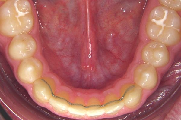 Retainer, Kieferorthopädie an der Parkinsel, Ludwigshafen Herausnehmbare Zahnspangen