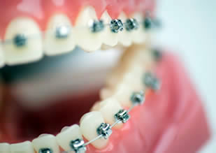 Herausnehmbare Zahnspangen