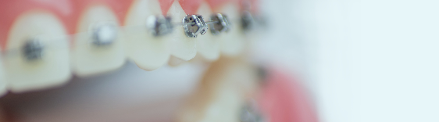 Nahaufnahme einer festen Zahnspange, Kieferorthopädie an der Parkinsel, Ludwigshafen