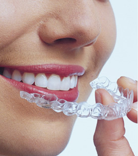Invisalign®