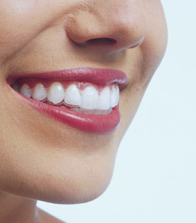 Invisalign®