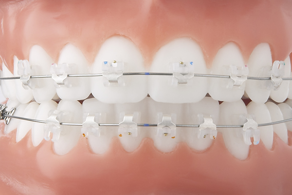 Transparente feste Zahnspange, Kieferorthopädie an der Parkinsel, Ludwigshafen Herausnehmbare Zahnspangen