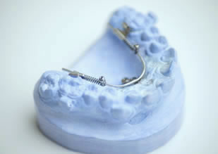 Herausnehmbare Zahnspangen