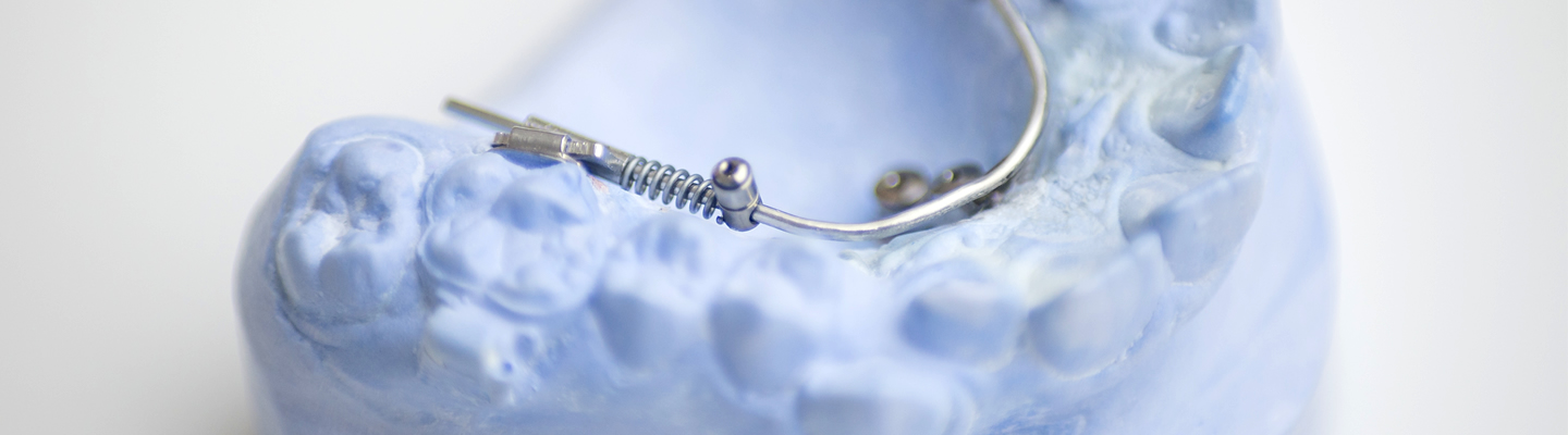 Nahaufnahme von Minischrauben und Implantaten auf Gipsabdruck eines Kiefers, Kieferorthopädie an der Parkinsel, Ludwigshafen